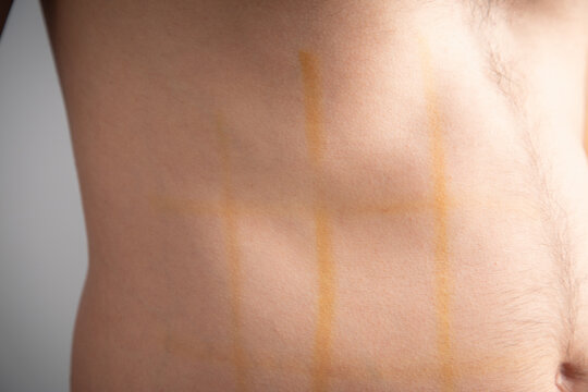 Caucasian man with a iodine on body.