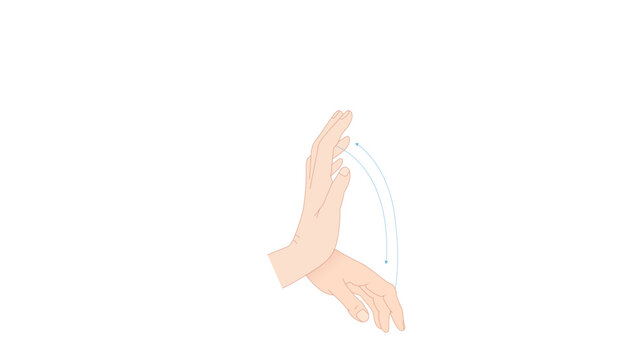  Asterixis, Medical illustration showing wrist drop, a characteristic clinical feature of radial nerve palsy, with inability to actively extend the wrist and fingers.