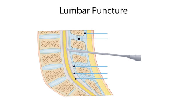  Lumbar Puncture, Medical illustration showing a lumbar puncture procedure, with a spinal needle passing through the lumbar vertebral structures into the subarachnoid space to obtain cerebrospinal
