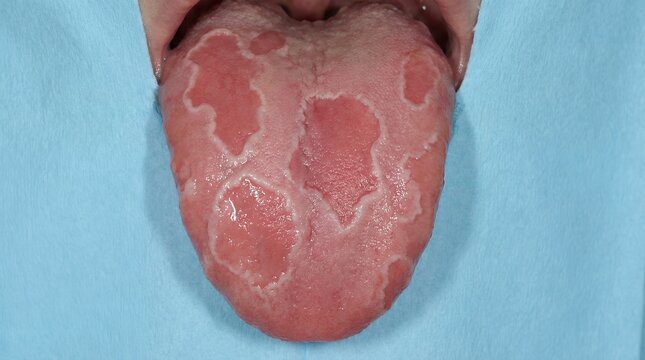 Geographic tongue showing benign migratory glossitis with distinct map-like lesions during a clinical dental examination for medical pathology education