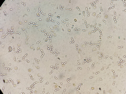 Yeast or candida cells and epithelial cells under microscope. Microscopy image showing Yeast or candida cells in urine.
