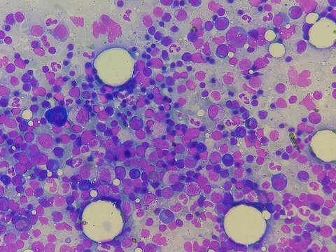 Bone marrow study. Dimorphic anaemia. Normocellular marrow showing trilinear hematopoiesis with mildly increased plasma cells. 