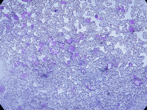 Bone marrow study. Dimorphic anaemia. Normocellular marrow showing trilinear hematopoiesis with mildly increased plasma cells. 