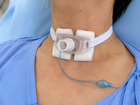 Tracheostomy 