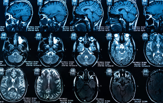 Axial MRI brain scan on medical display