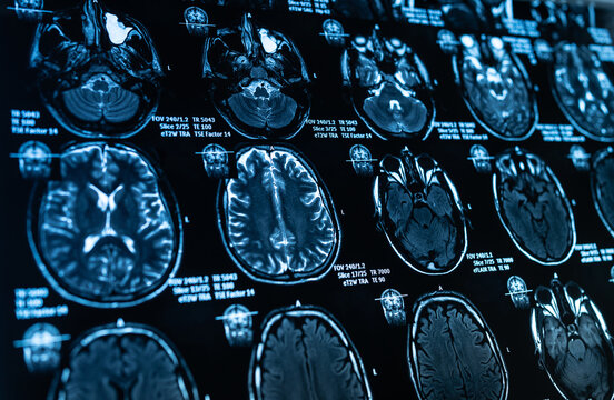 Magnetic resonance imaging of human brain