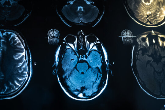 Close up of human brain MRI scan