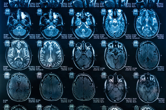 Brain MRI scans showing multiple cross sections