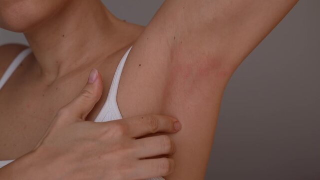 Young woman shows irritated armpit skin with redness and rash, touching sensitive underarm area on gray background
