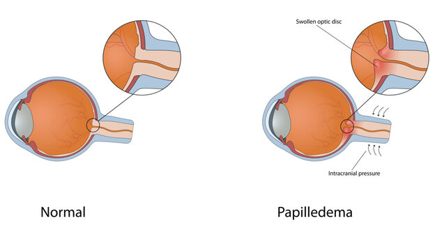 Papilledema vector illustration
