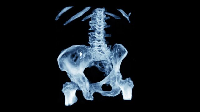 X-ray style 3D CT rendering of the human pelvis, hip joints and lumbar spine in glowing blue on a black background, medical animation