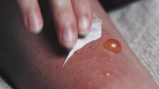 closeup of ointment applied to painful blisters infected with fluid discharge.