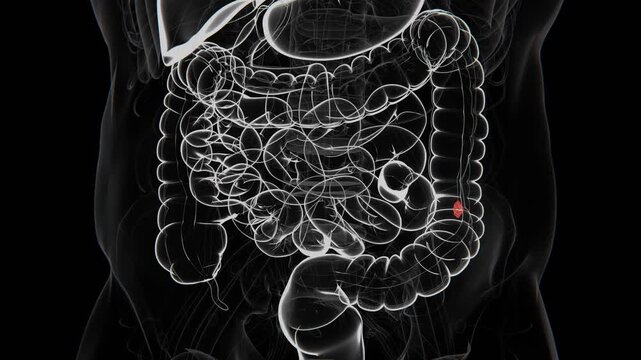 Angiodysplasia is an abnormal collection of enlarged and fragile blood vessels, most commonly found in the lining of the gastrointestinal tract in 4K UHD Video