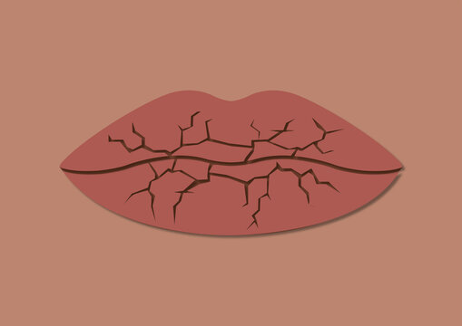 Chapped lips, illustration