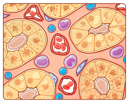 Acute glomerulonephritis tubulointerstitial, illustration