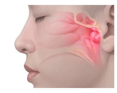 Enlarged adenoids, illustration