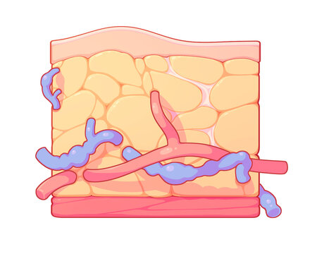 Blood clot in a chest vein, illustration