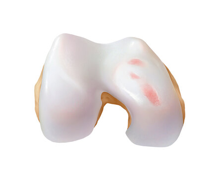 Knee osteoarthritis grade 2, illustration