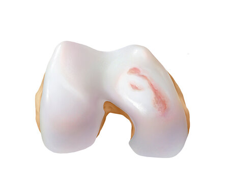 Knee osteoarthritis grade 3, illustration
