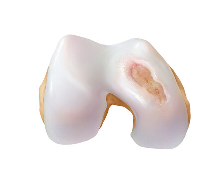 Knee osteoarthritis grade 4, illustration