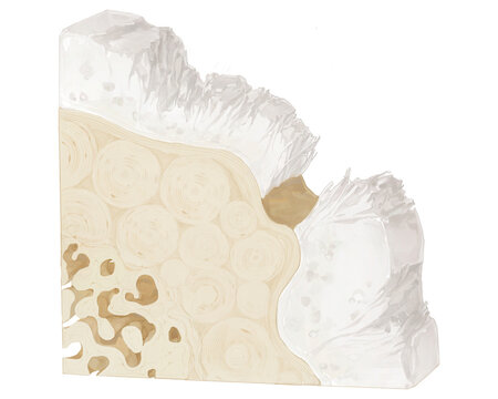 Moderate osteoarthritis, illustration