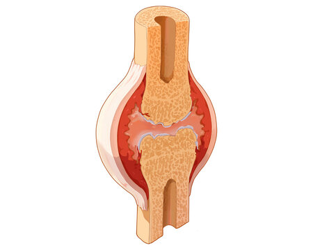Mid-stage rheumatoid arthritis, illustration
