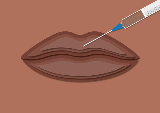 Cosmetic lip injection, conceptual illustration
