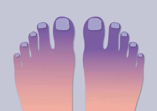 Raynaud's syndrome, conceptual illustration