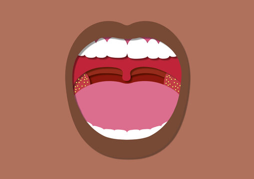 Tonsillitis, conceptual illustration