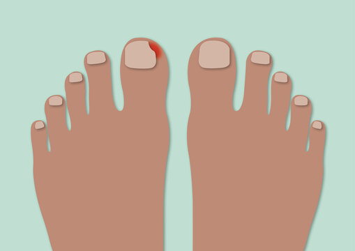Ingrown toenail, illustration