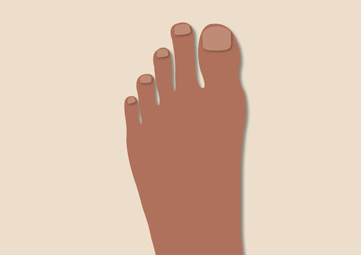 Morton's toe, illustration
