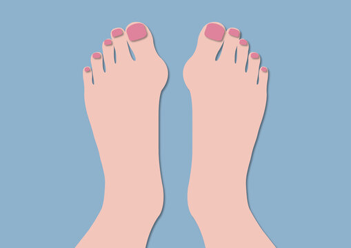 Bunions, illustration