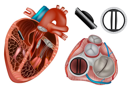 Mechanical Heart Valve Replacement in Mitral Position, Detailed Cardiac Anatomy Medical Illustration. Mechanical prosthetic heart valve implanted in the mitral valve position