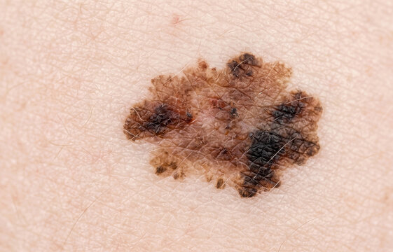 Close up of atypical dysplastic nevus or suspected melanoma with irregular borders