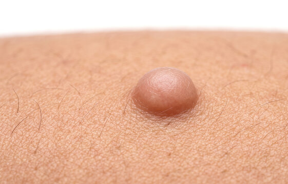 Macro shot of a raised dermatofibroma or intradermal nevus skin nodule on fair skin