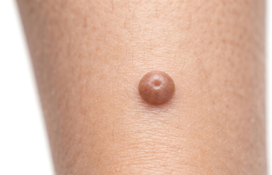 Close up of a raised benign mole skin tag or fibroma on human skin