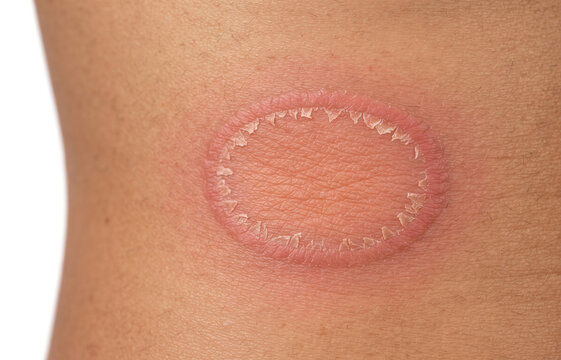 Tinea corporis ringworm fungal infection showing circular red scaly lesion on skin