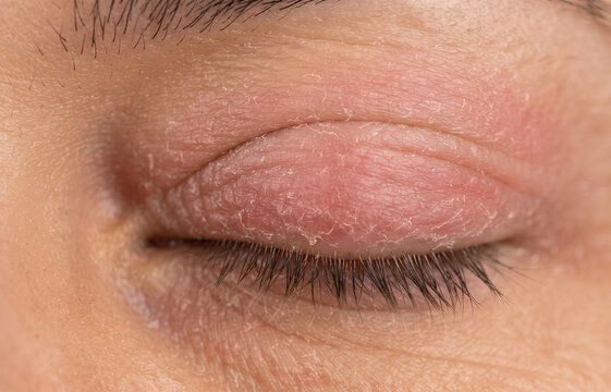 Eyelid dermatitis blepharitis with dry flaky peeling skin and redness close up