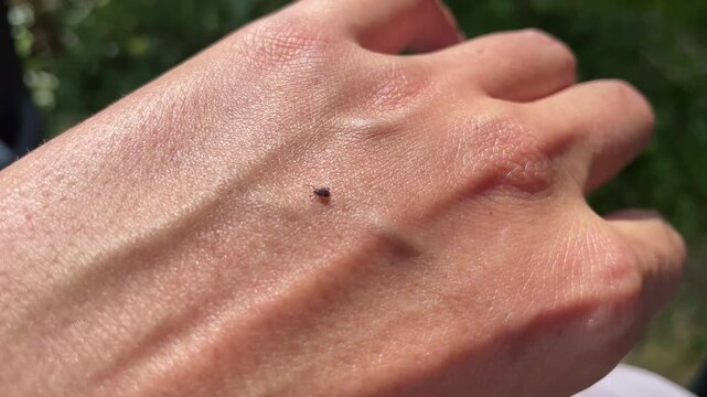 A tick crawling on a person's arm human skin macro close up