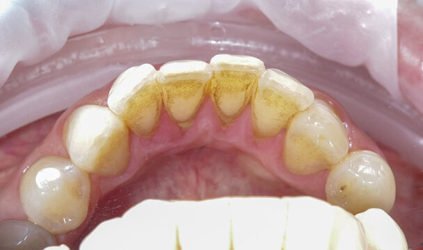 Dental plaque and tartar on the inner surface of lower teeth. Oral hygiene concerns