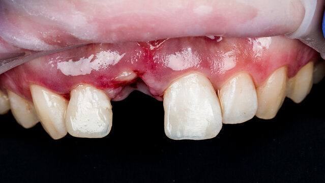 Close-up clinical view of the upper front teeth and gums showing traumatic injury, redness, swelling and bleeding of the gingival tissue.Dental trauma, oral injury, tooth damage