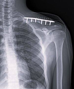 Clavicle Fracture X-ray Showing Collarbone Fixed with Metal Plate and Screws