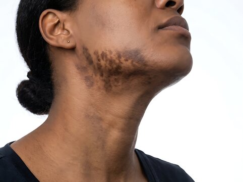 Young woman with dark skin and visible hyperpigmentation on jawline and chin