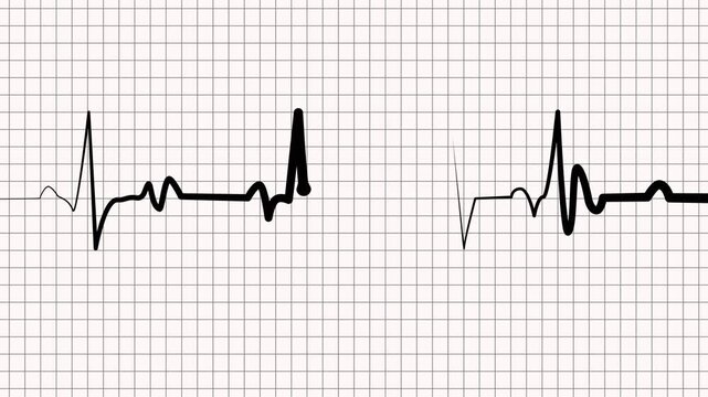 Ecg heartbeat line irregular pulse pattern medical background animation