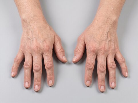 Advanced Rheumatoid Arthritis Hand Deformity with Ulnar Finger Deviation