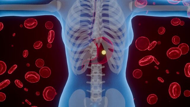 Stomach cancer progression in female body, 3D rendered x-ray style animation, digestive system disease
