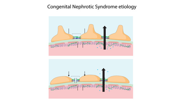 Congenital Nephrotic Syndrome etiology, Medical illustration showing the underlying glomerular structural abnormalities associated with congenital nephrotic syndrome, 