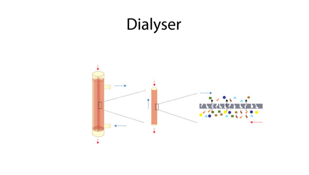 Dialyser, Medical illustration depicting a dialyser used during hemodialysis, showing the flow of blood and dialysate across a semipermeable membrane for removal of waste products, 