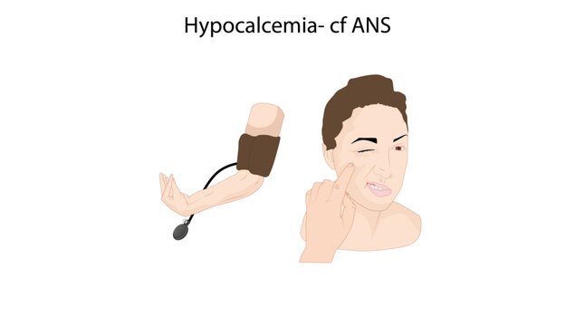 Hypocalcemia- cf ANS, Medical illustration demonstrating clinical assessment associated with hypocalcemia, highlighting neuromuscular irritability and signs that may be elicited during physical 