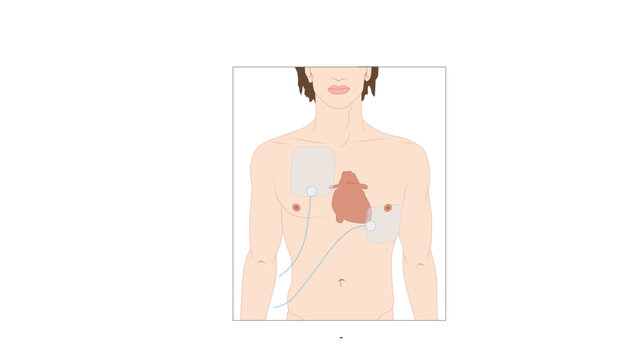  Transcutaneous Pacing, Medical illustration showing a cardiac pacemaker system with pacing leads extending from the implanted device into the heart. 